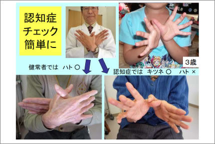 アルツハイマー型認知症のケア